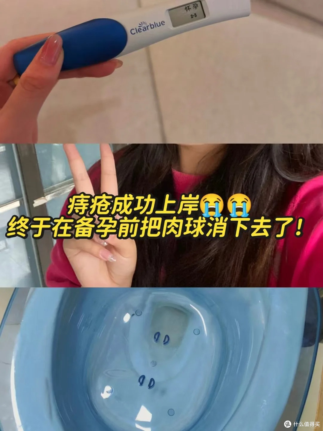 痔疮肉球真的摸不到啦！可以安心备孕了！ 