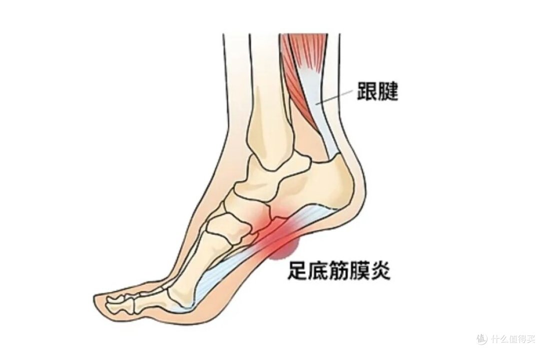 运动后足底痛?可能细节没做好 医生不会告诉你的护理“秘密”