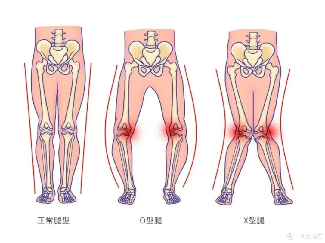 为啥膝关节总疼肿?骨科专家拆解 4 大诱因,对症护膝不踩坑