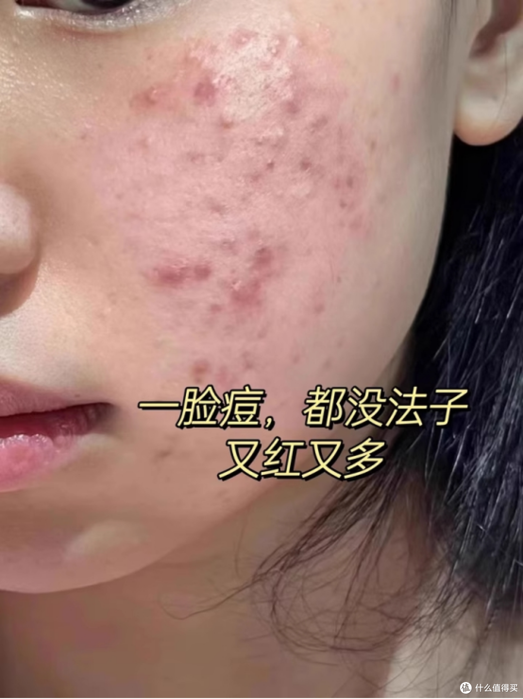 祛痘精华液哪个牌子最好用，2025秋冬祛痘精华，闭口痘肌根源修护