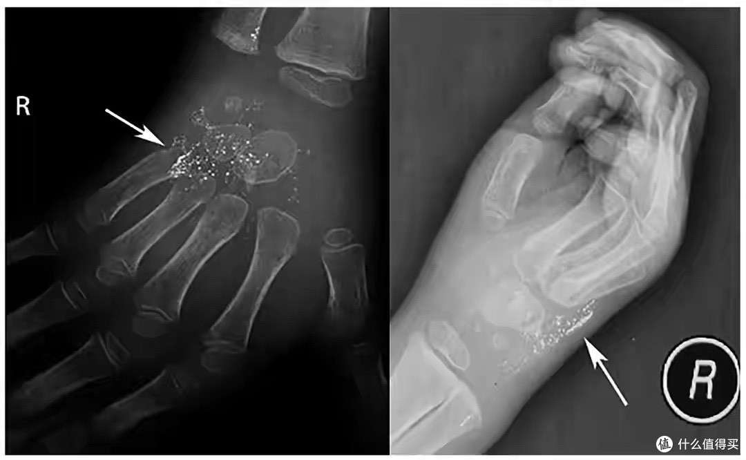 从眼眶到腹腔,水银温度计造成的真实病例震惊医生:不是小事!