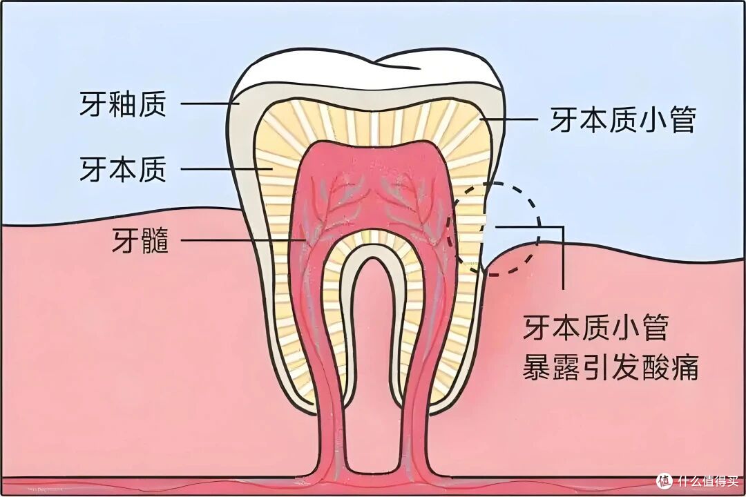洁牙后短期牙齿敏感的原因及恢复特点