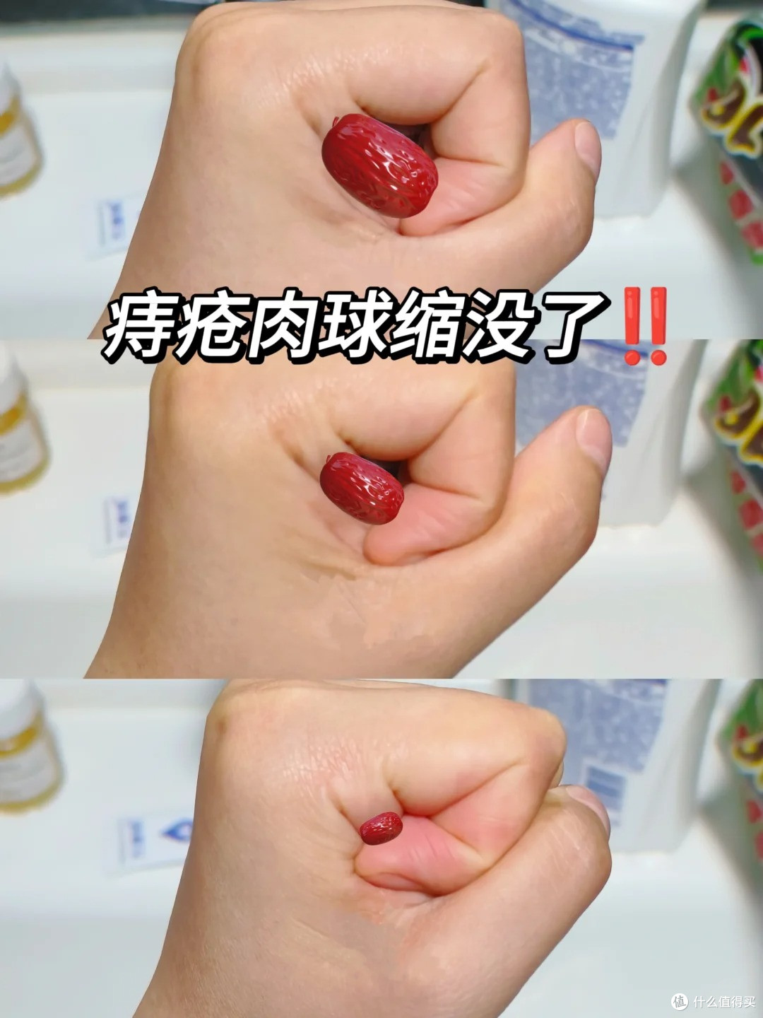 痔疮肉球脱出，肿大疼痛，一招搞定！