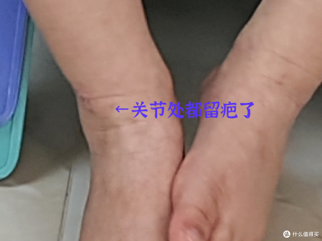 一年来的儿童湿疹护理的心得,干货满满!