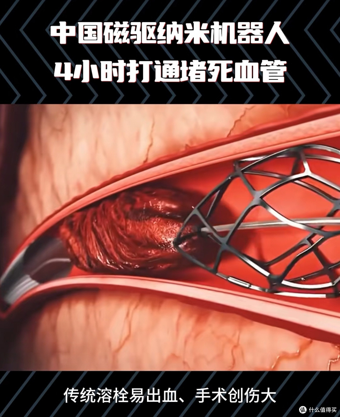 打一针,4小时疏通血管:中国磁驱纳米机器人如何改写救命规则?
