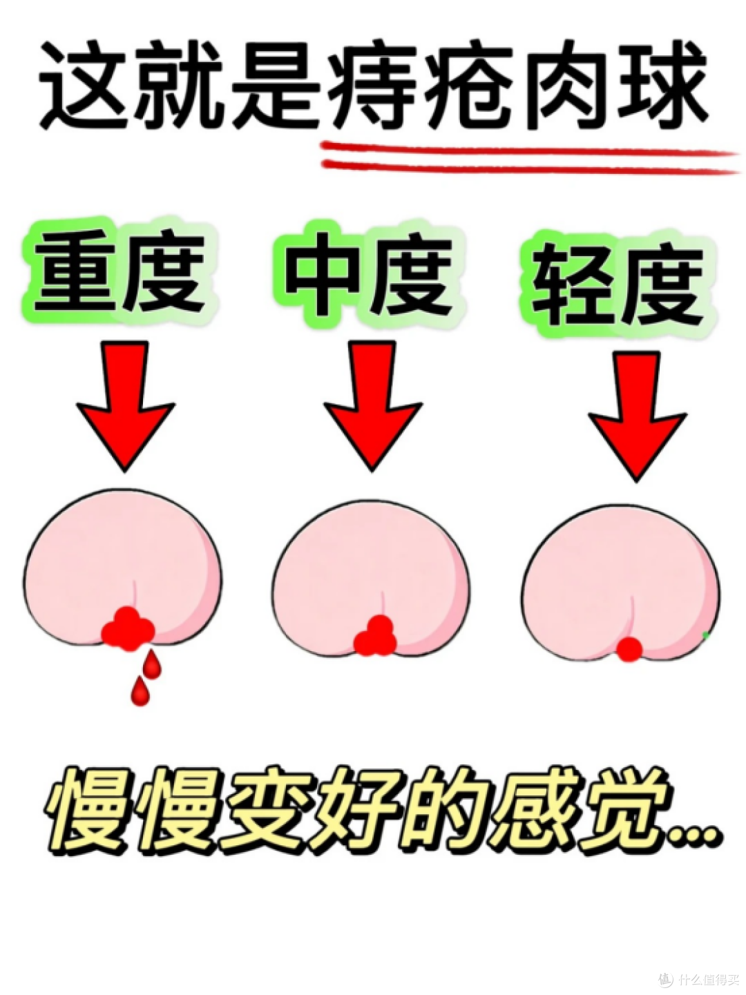 痔疮悄悄分轻重，你对号到哪一档？