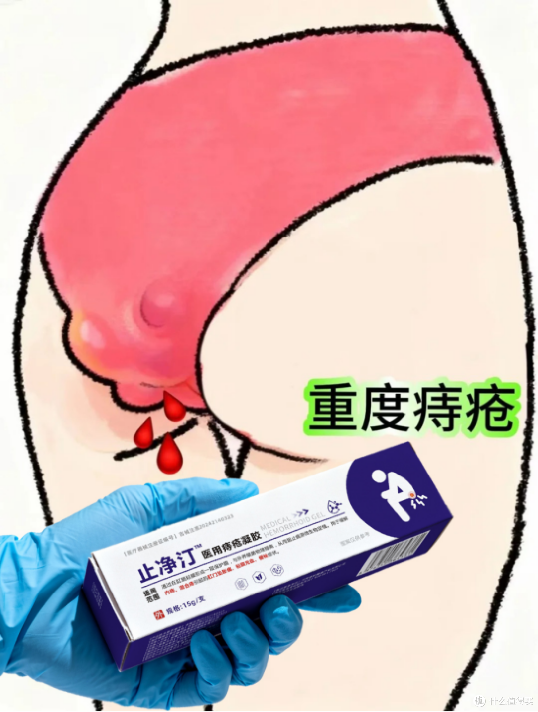 痔疮悄悄分轻重，你对号到哪一档？