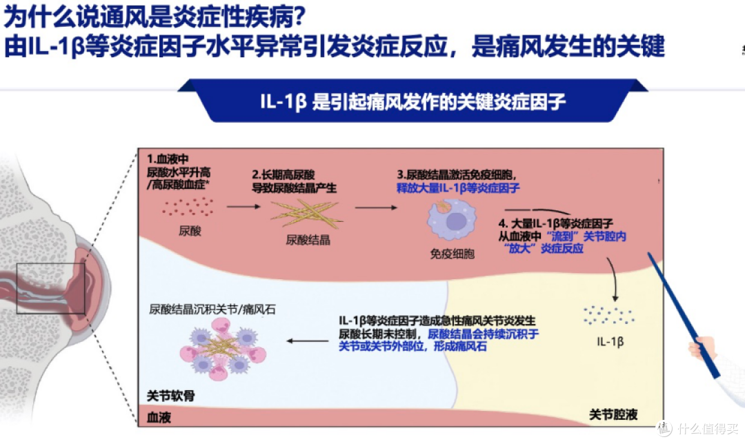 仅靠降尿酸药不够？专家解读为何“抗炎”是痛风治疗的另一半