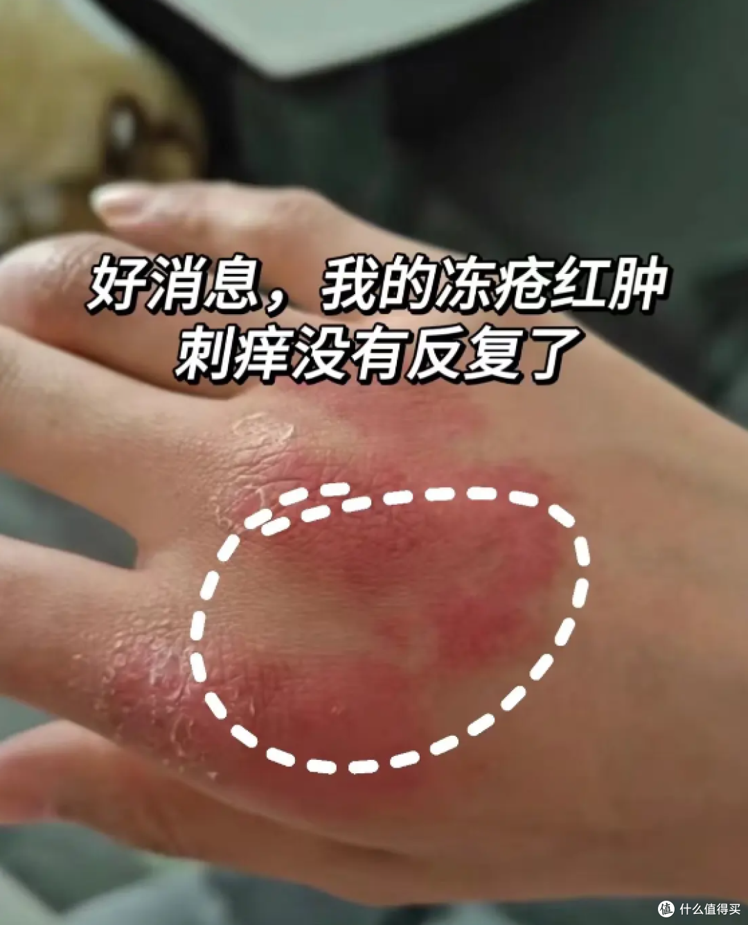 年年冻疮手又红又肿?跟我这样护理,一周告别“红萝卜”!