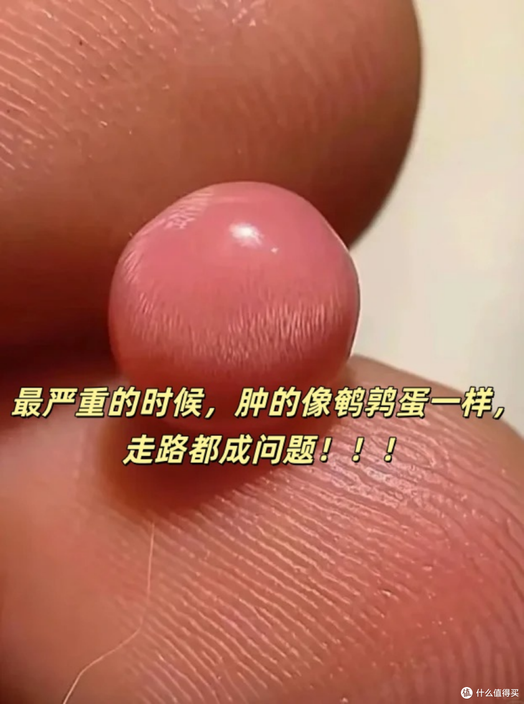 痔疮肉球怎么消？4个不手术自愈的窍门！真实分享！