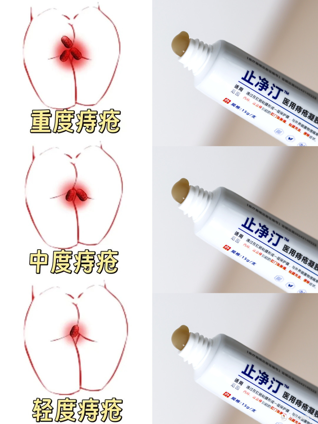 痔疮反复坠出疼痛怎么办？