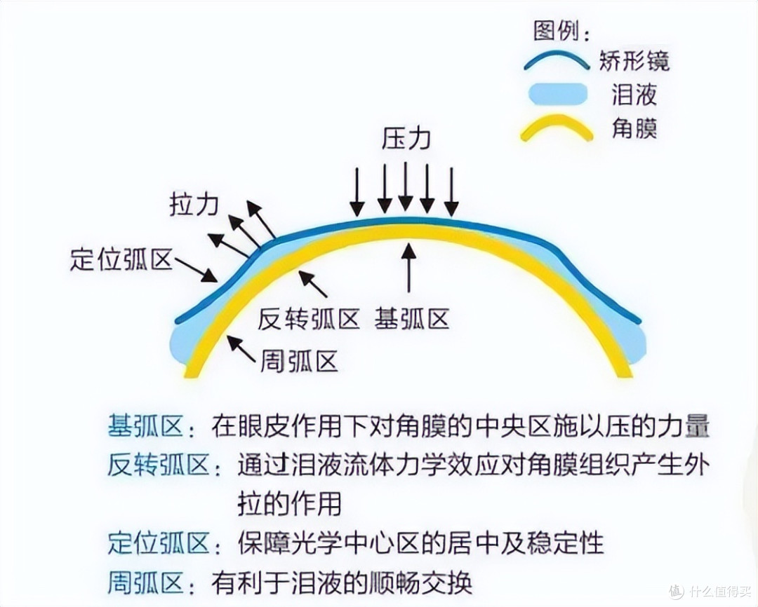 “OK镜不只是眼内接触型的了”,眼外佩戴的OK镜你听过吗?