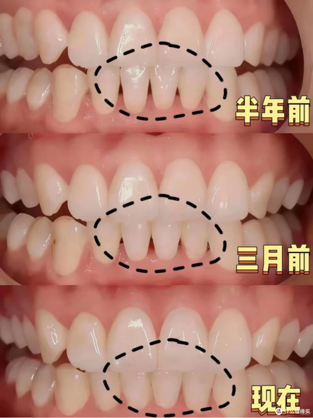 牙结石会自己掉吗？一篇讲清楚
