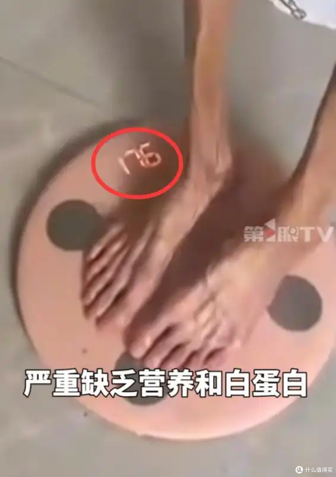 27岁女孩患胃萎缩离世，体重仅35斤，这些胃病信号要警惕
