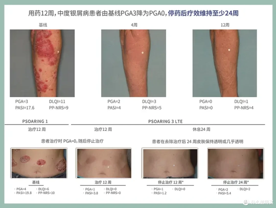 从自卑到自信,一个银屑病患者的治愈之路,始于正确规范用药!