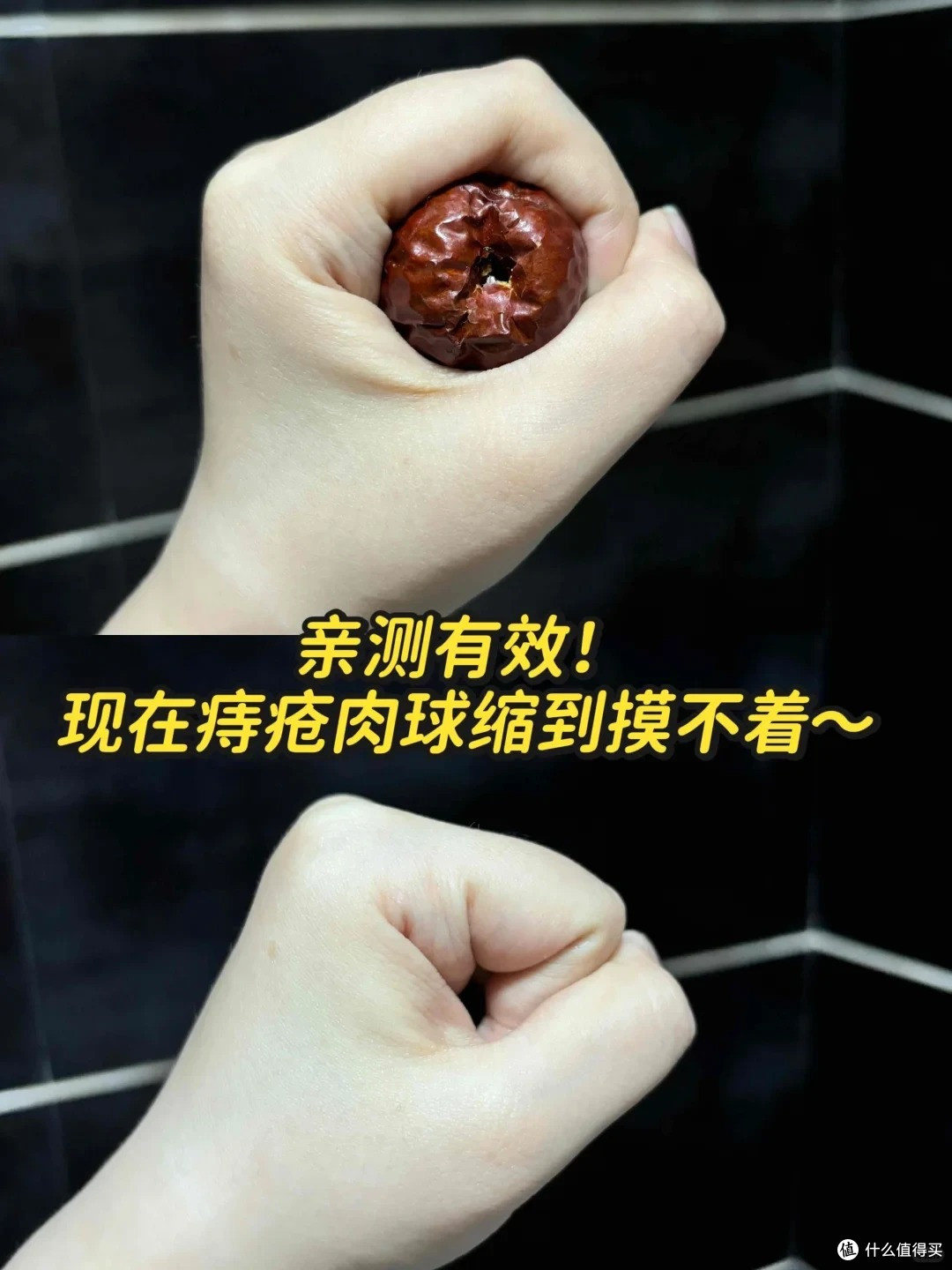 多年的痔疮！真的慢慢消除了！