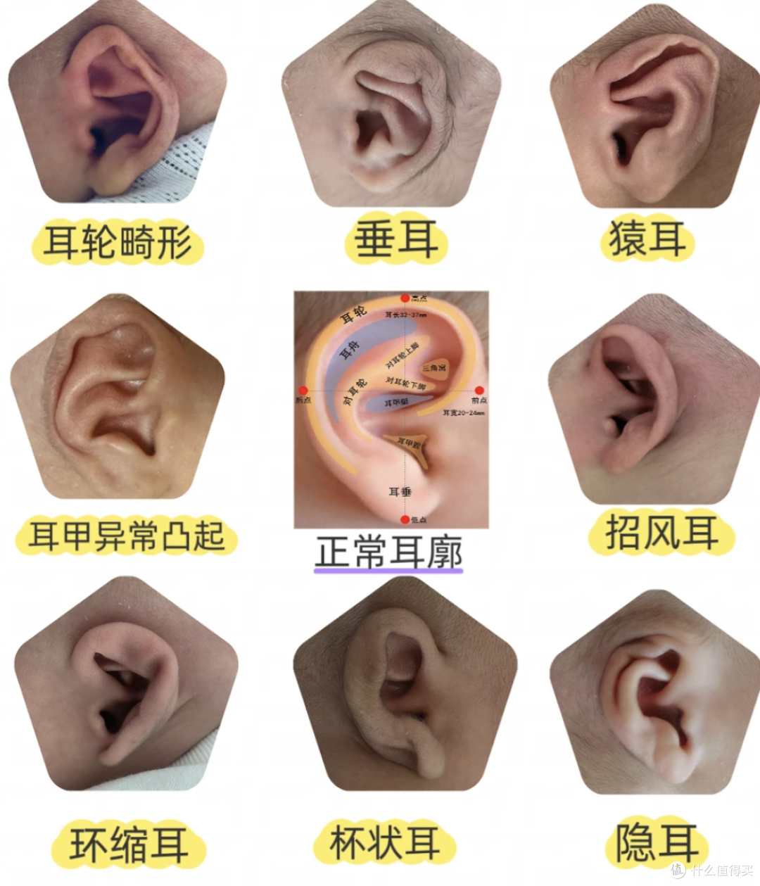 娃耳朵矫形花1万2值吗?医生坦言:这钱省了,将来可能花10万!