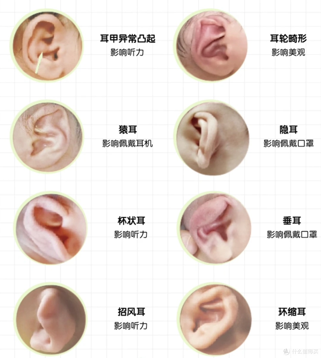 娃耳朵矫形花1万2值吗?医生坦言:这钱省了,将来可能花10万!