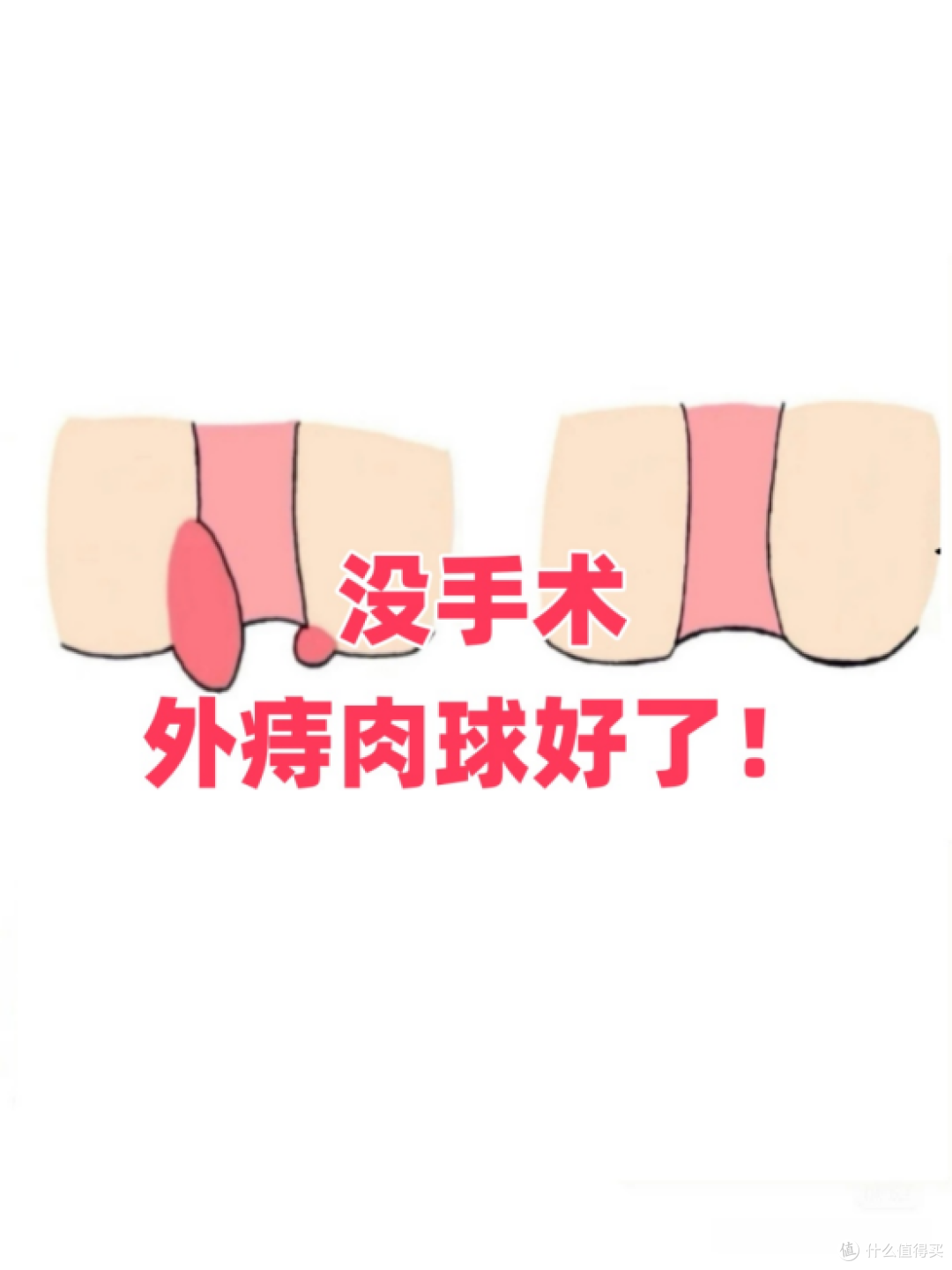 外痔肉球,没做手术恢复了!