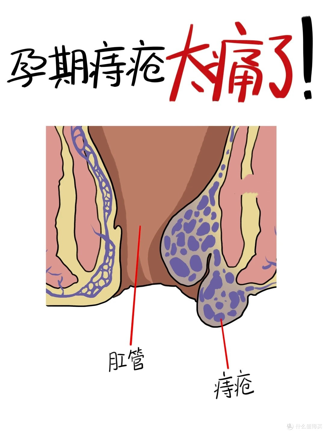 孕期痔疮真的太痛苦了!