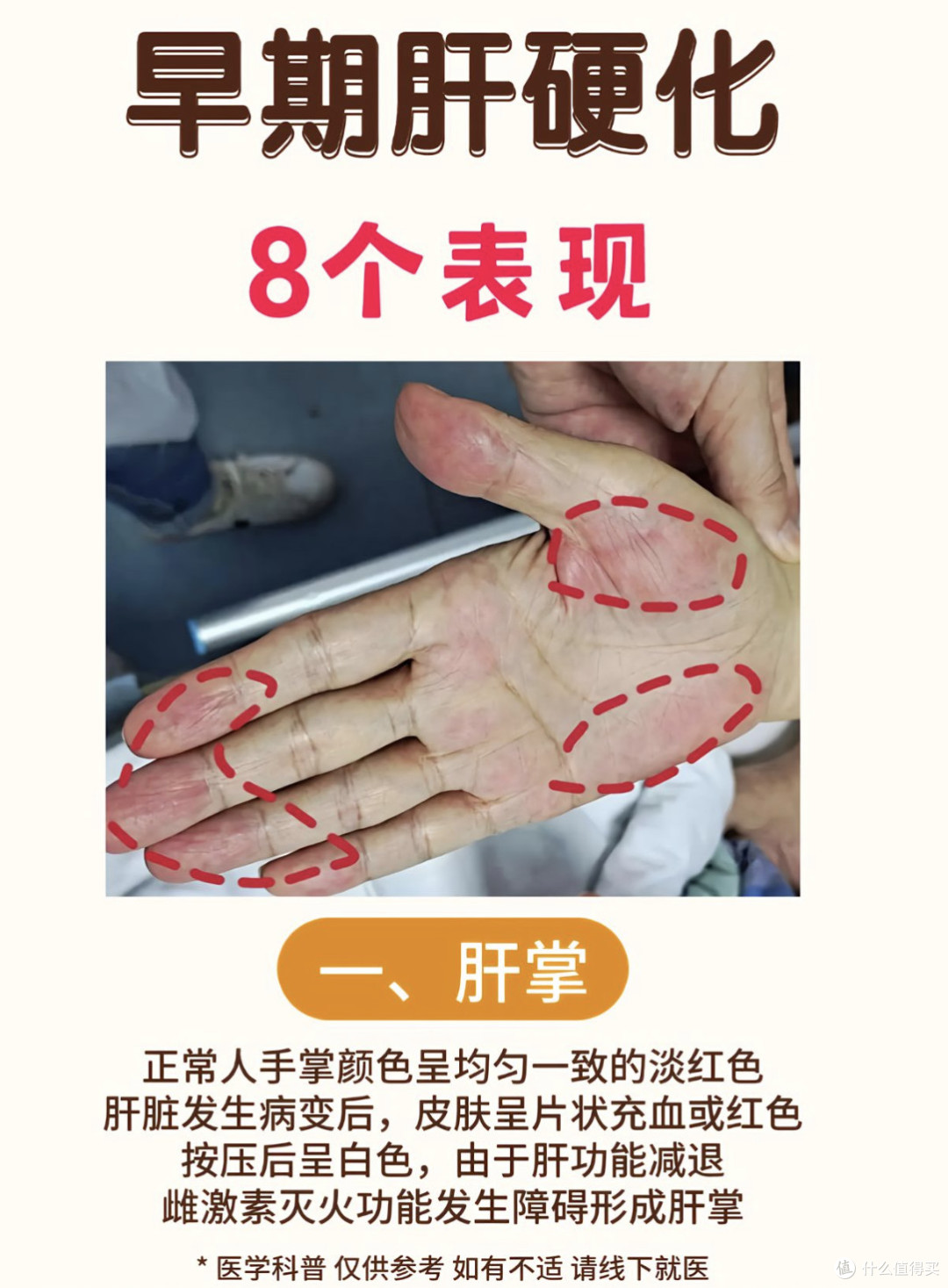 张雪掌红疑肝掌,网友提示及时就医, 别像张雪峰唇紫再酿悲剧