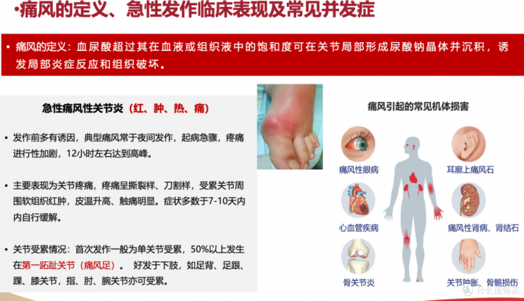 高尿酸不痛就不用管?错!从生活方式到药物,完整调理攻略来了