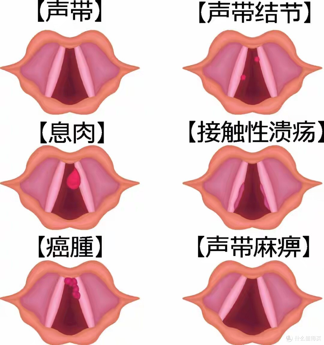 这些位置长了息肉,一定要当心!尤其这种几乎 100% 会癌变