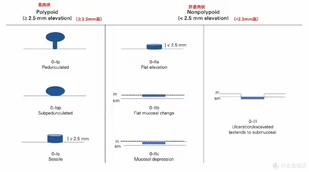 这些位置长了息肉,一定要当心!尤其这种几乎 100% 会癌变