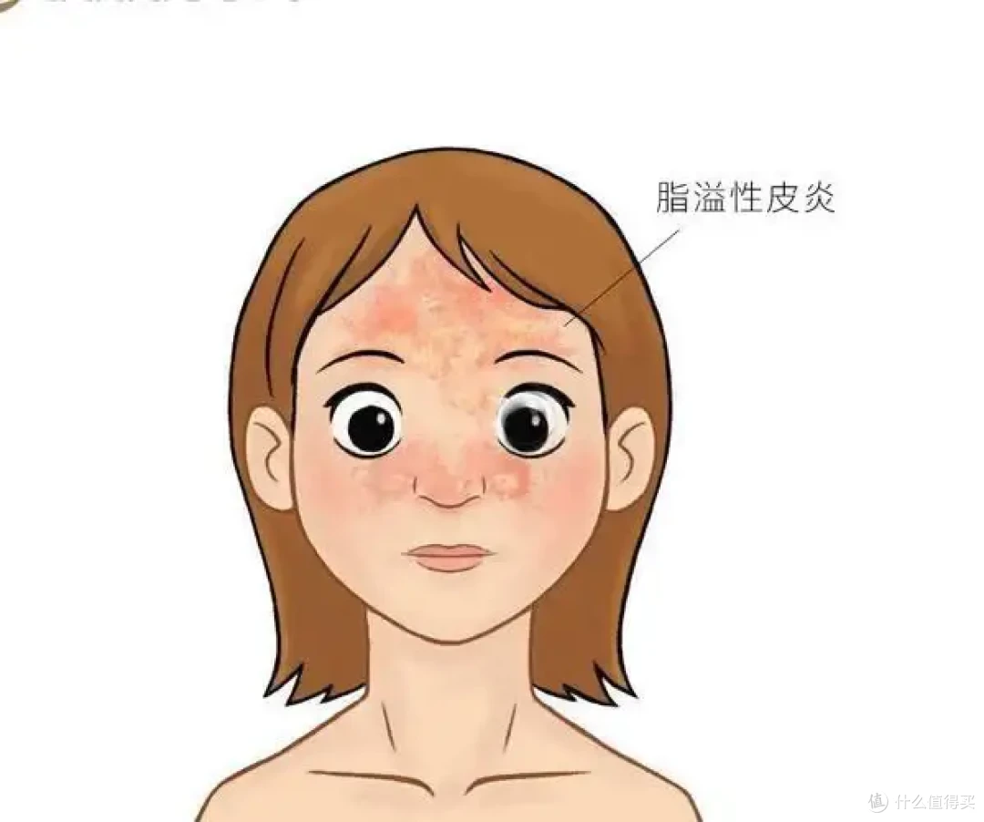 脂溢性皮炎自救笔记:当你的皮肤“灰浆”告急了