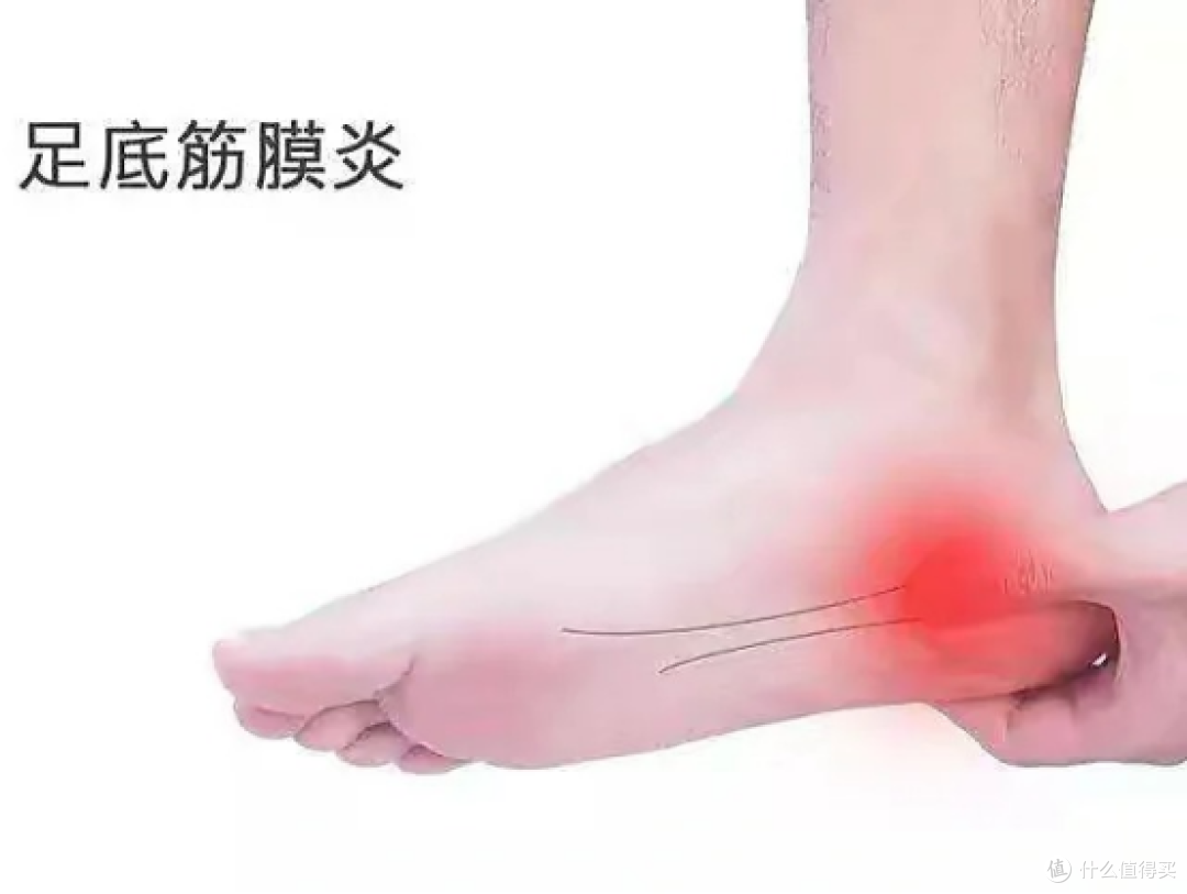 折磨我两年的脚底筋膜炎好了！