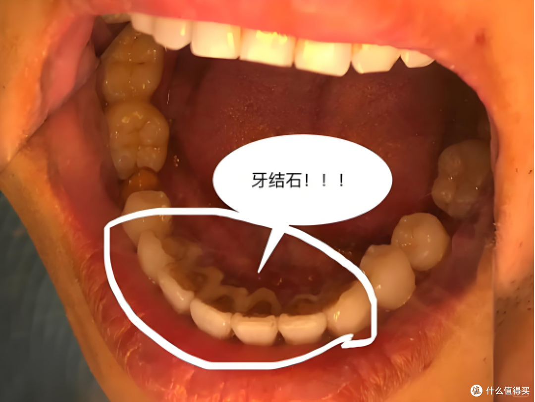 牙结石终于掉光了！分享几个超级实用的去牙石小妙招！