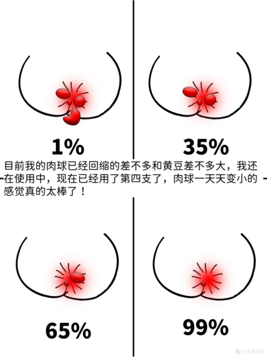 分享一下痔疮拉血到痊愈的全过程