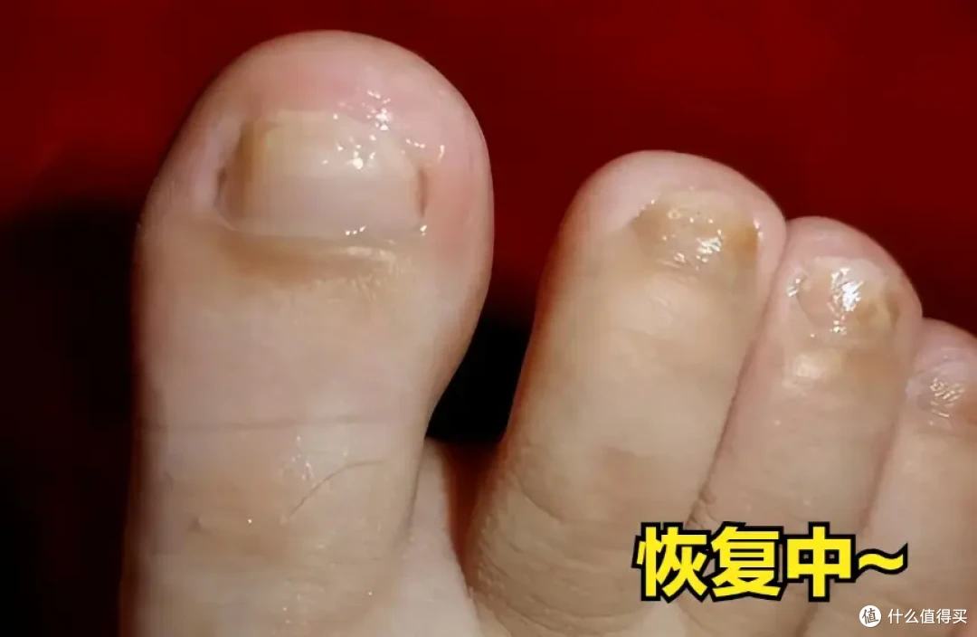 恢复白嫩亮甲,伊甲复方聚维酮碘轻松告别灰指甲困扰