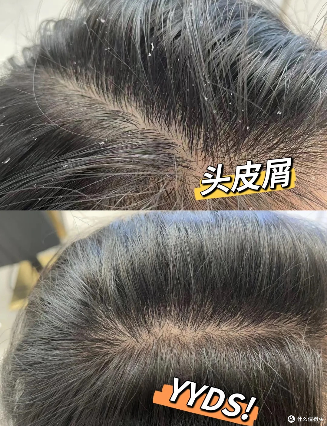 熬夜党的“头等烦恼”:头皮屑、头痒、大油头,终于有解了!