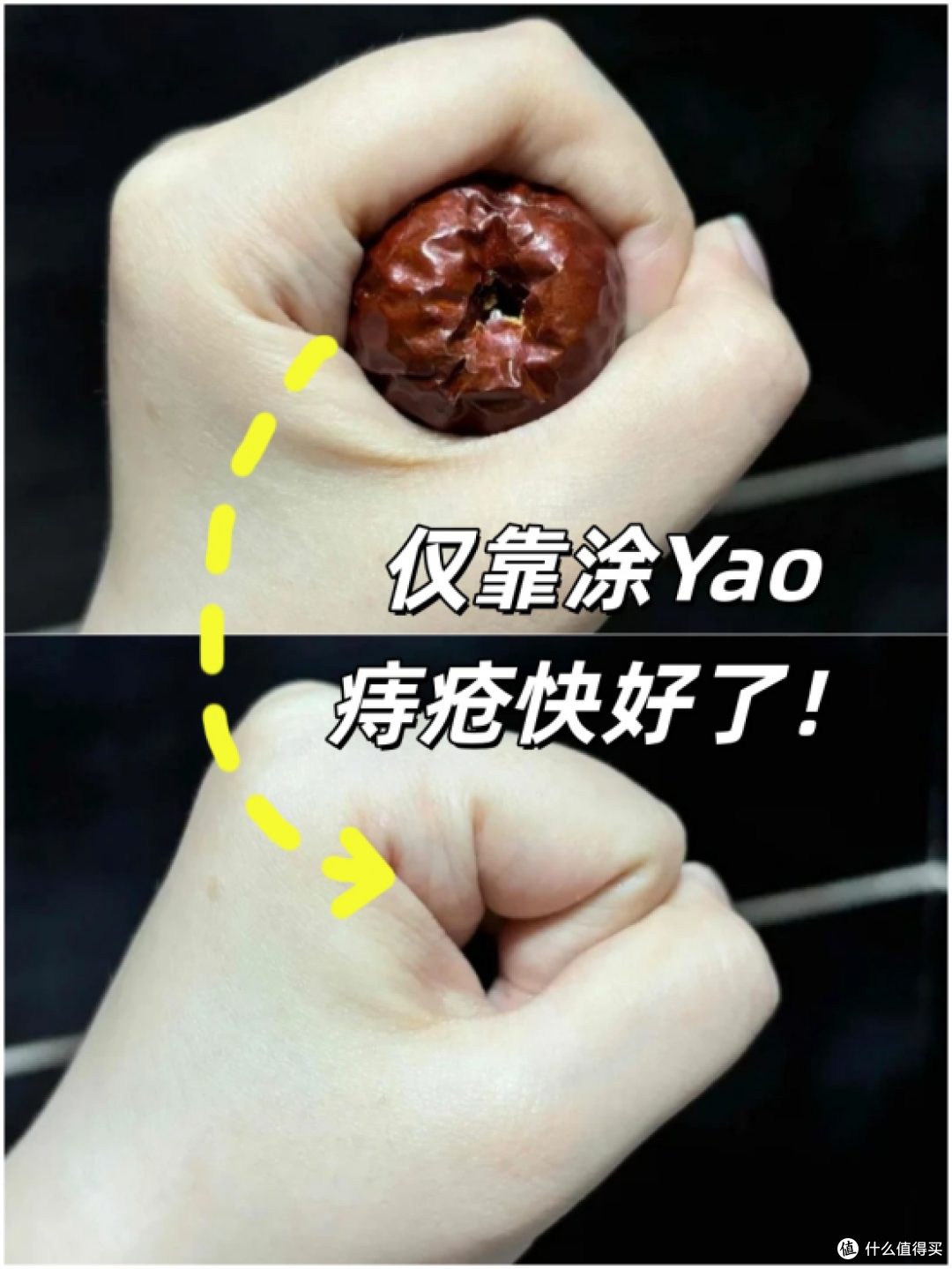仅靠涂药,痔疮快好了!哈哈哈