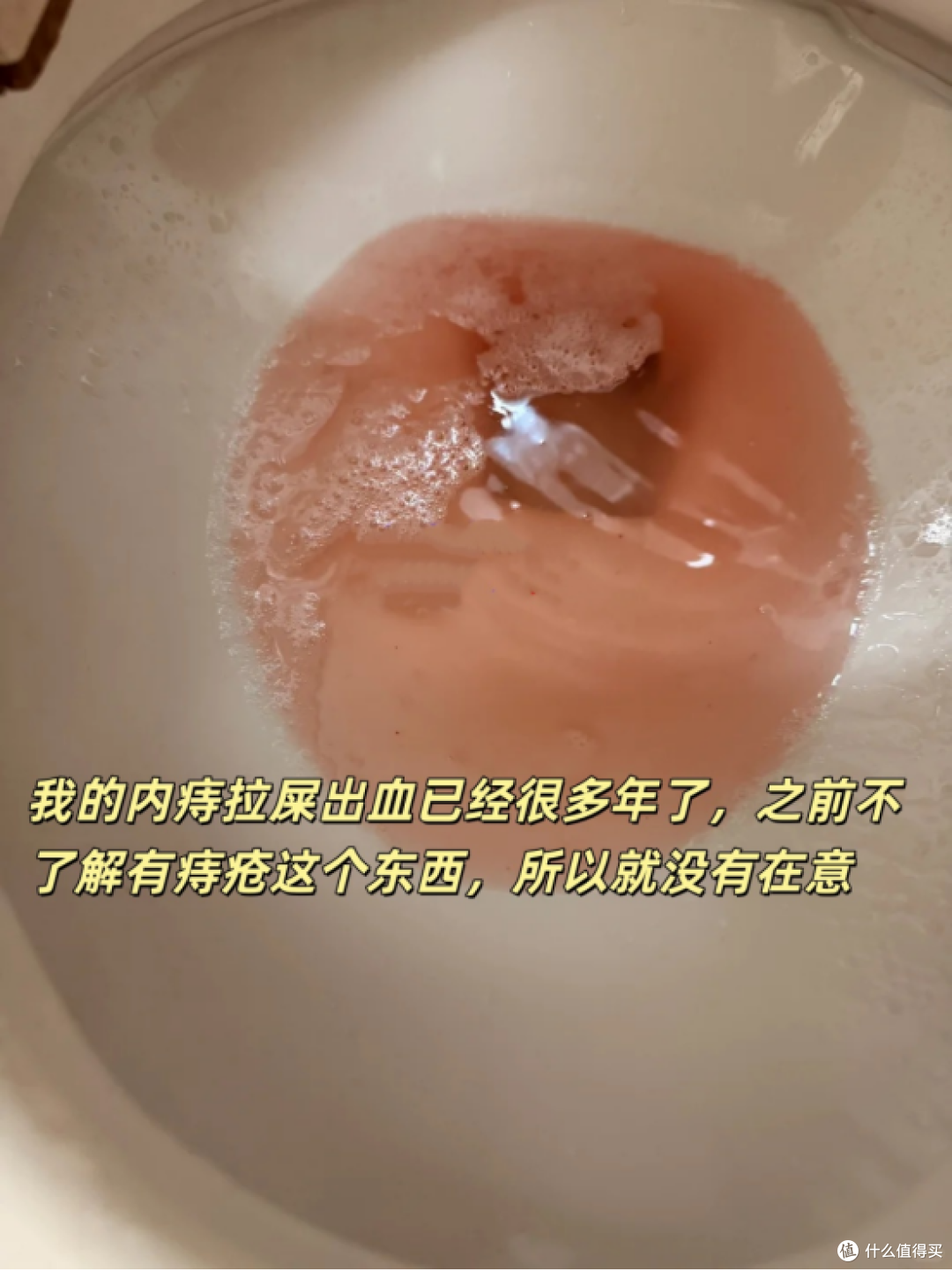 仅靠涂药,痔疮快好了!哈哈哈
