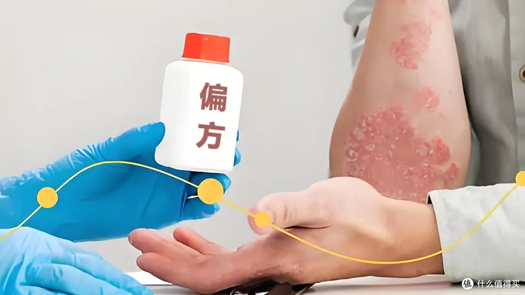 银屑病远离偏方陷阱,科学用药看这里!