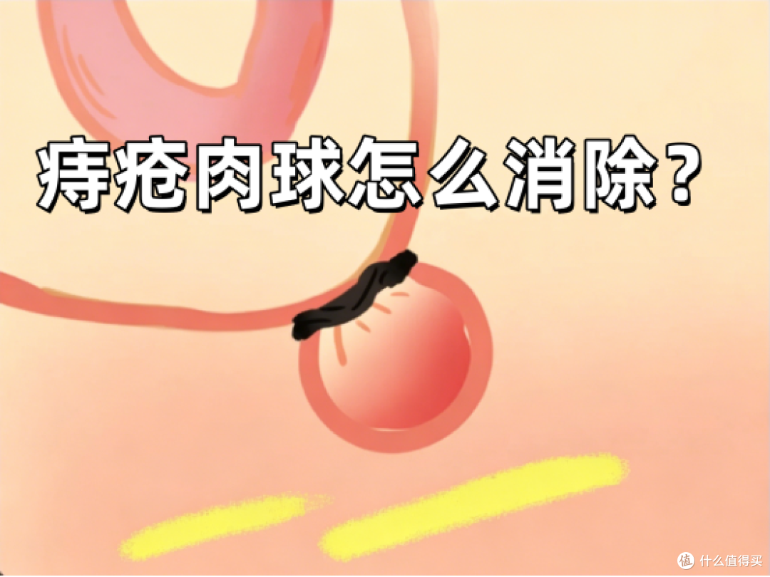痔疮肉球脱出,出血已恢复九成!说说我都做对了什么!