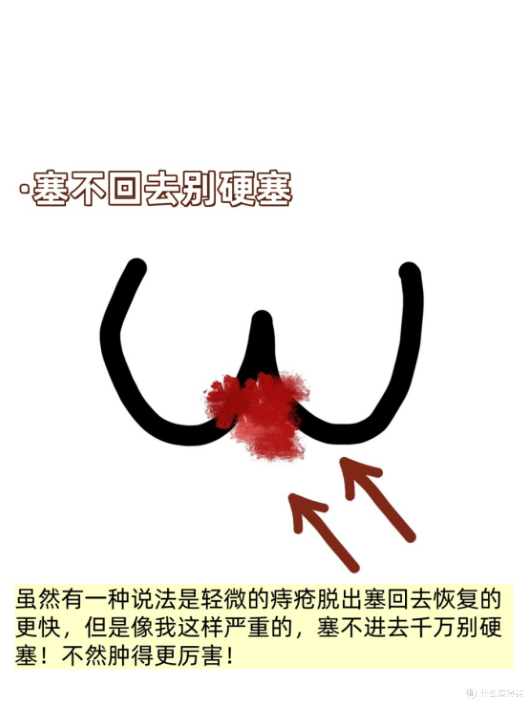 产后痔疮大爆发的自救指南!