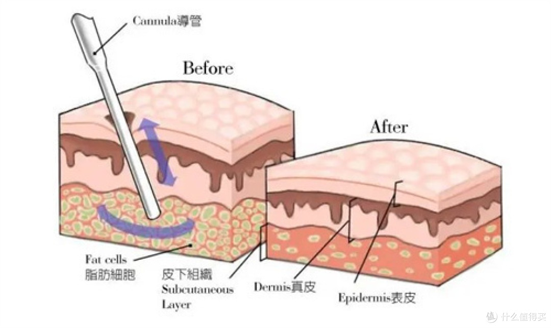 吸脂手术
