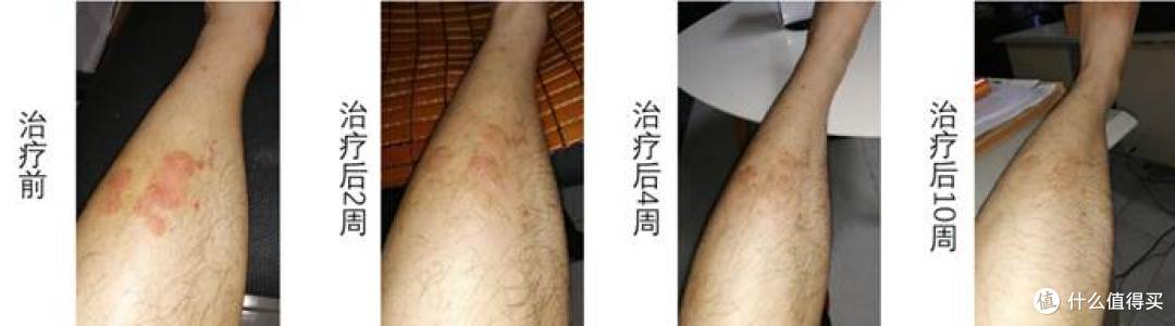 牛皮癣家中常备药物,激素、卡泊三醇和本维莫德怎么搭配使用?