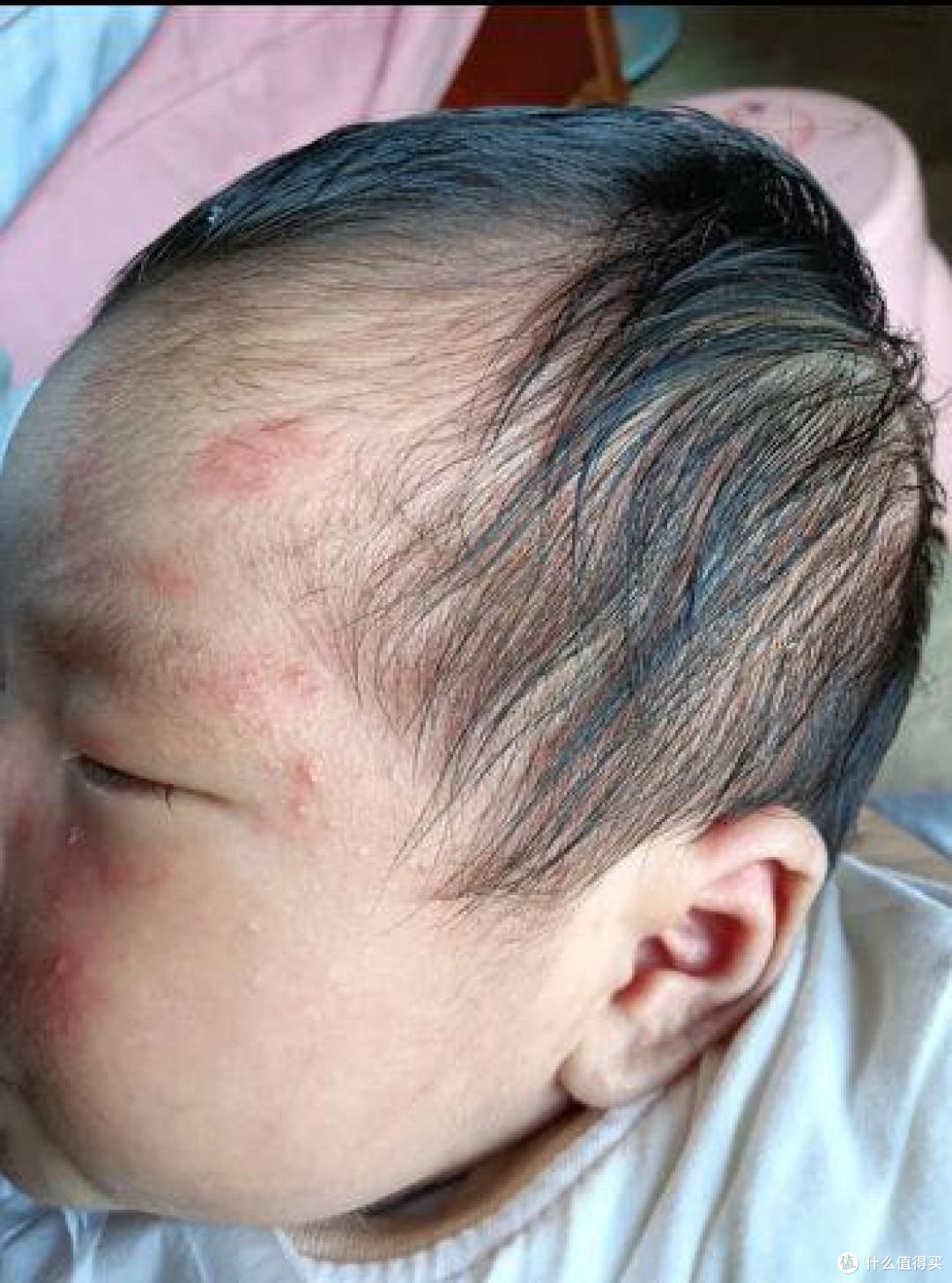 萌大夫喜美婴湿疹喷剂 vs 炉甘石洗剂，家里2岁崽的真实折腾记录