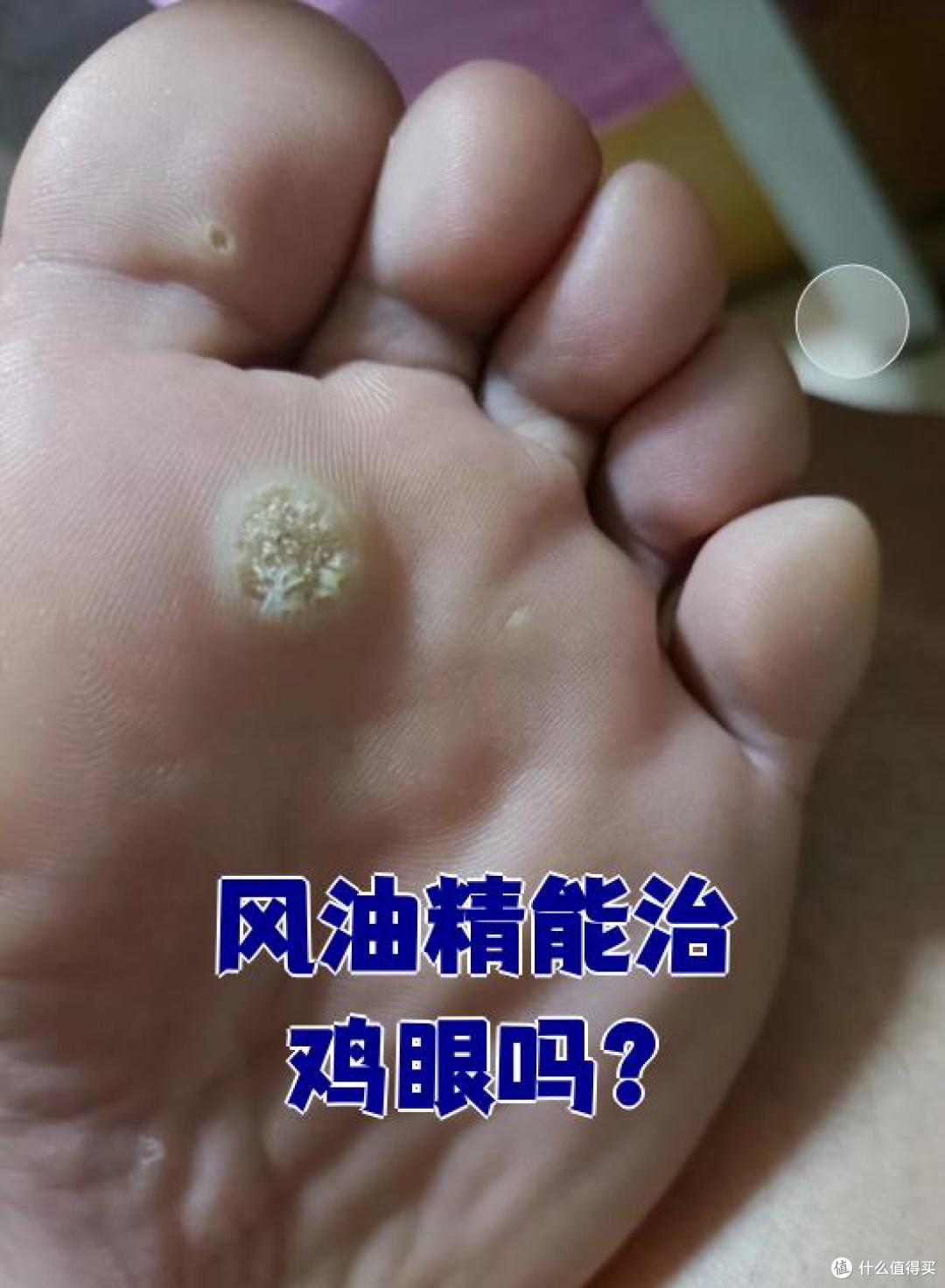 很多人都不知道,风油精才是“夏日神器”,几块钱搞定了无数难题
