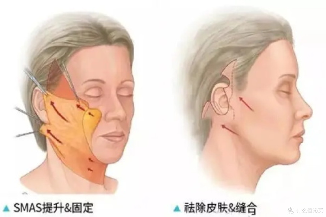 王召东筋膜提升实测:技术路线+恢复期+费用全记录