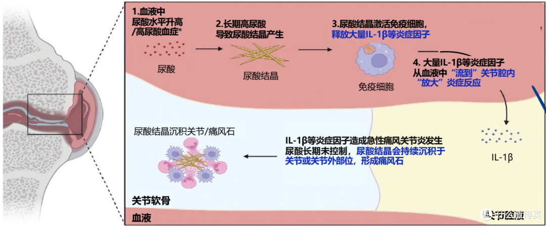 痛风从病因到治疗，2026年一篇看懂痛风全周期管理
