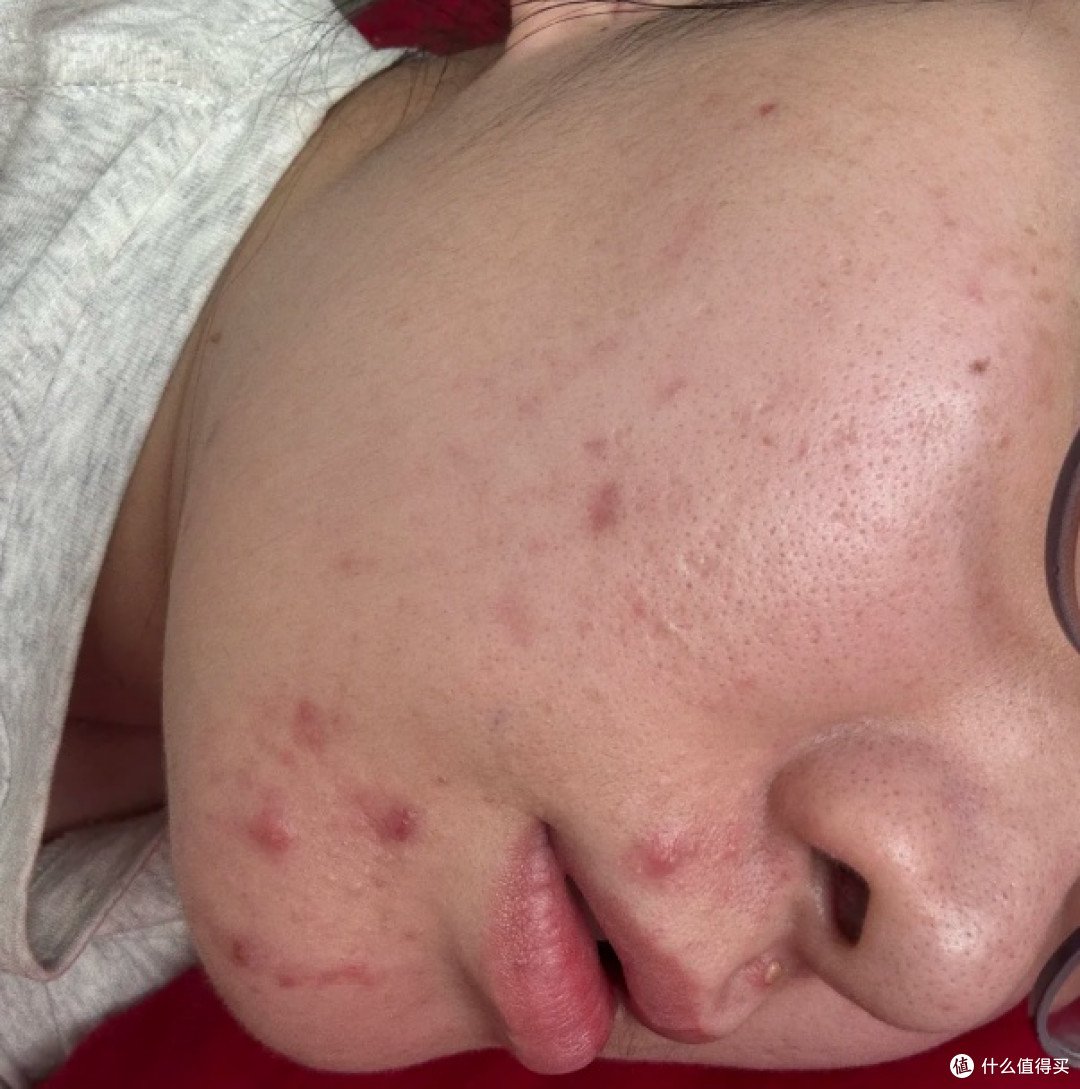 夏天长痘用什么泥膜 ?夏天疯狂爆痘用什么泥膜 4款祛痘泥膜实测