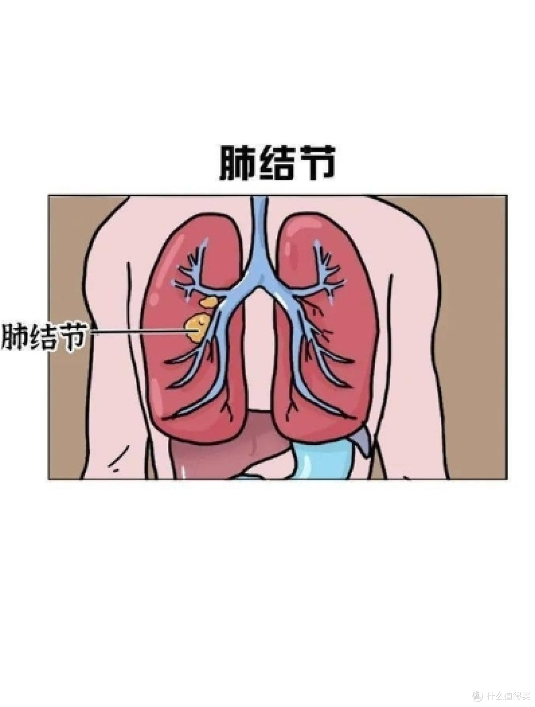 4mm肺结节8个月后复查消失了，我到底做了什么