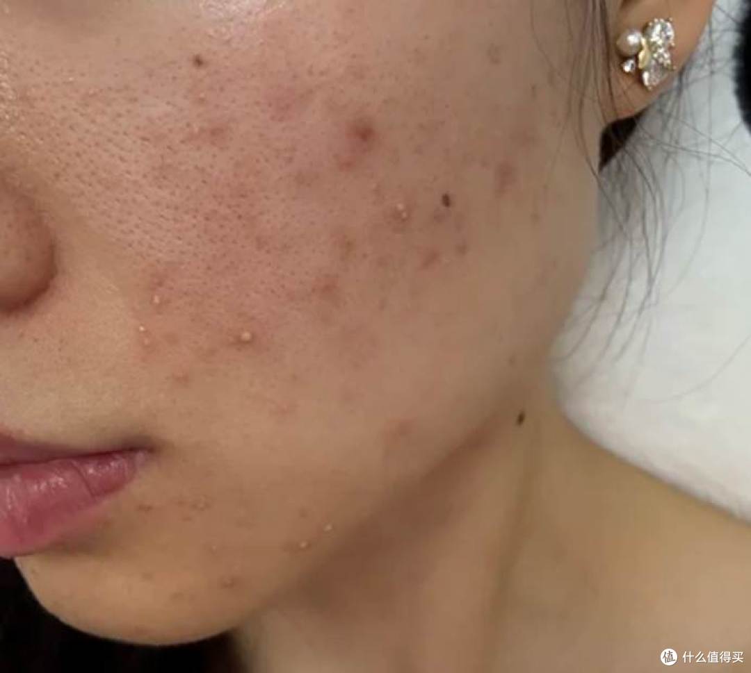 油皮去粉刺用什么泥膜 粉刺不断什么泥膜可以改善 这4款实用泥膜