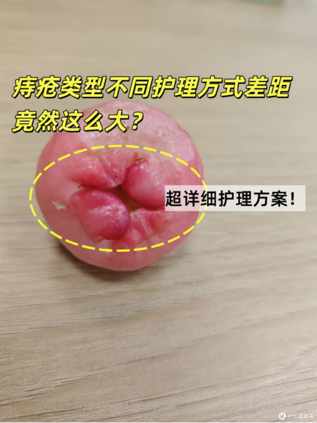痔疮类型不同护理方式差距竟然这么大?