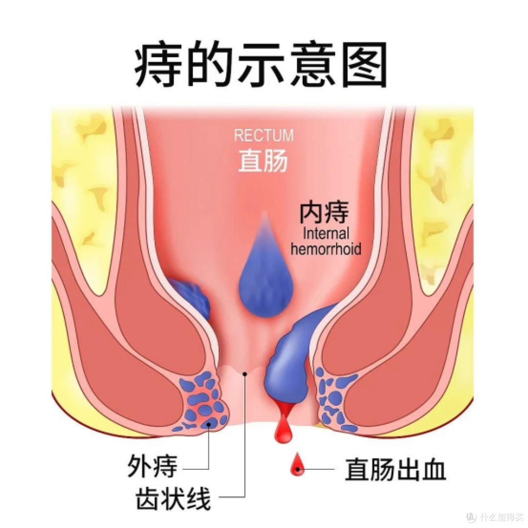 痔疮不是小问题！教你告别局部烦恼！